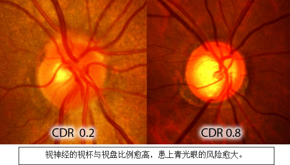 青光眼能玩游戏吗_青光眼可以打游戏吗_打手机游戏会得青光眼吗